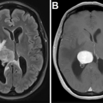Magnetic-resonance-imaging-of-the-brain-with-fluid-attenuated-inversion-recovery-(A)-and-gadolinium-enhanced-T1-weighted-(B)-images-demonstrating-an-avidly-contrast-enhancing,-well-demarcated-intraventricular-tumor-with-associated-vasogenic-edema.