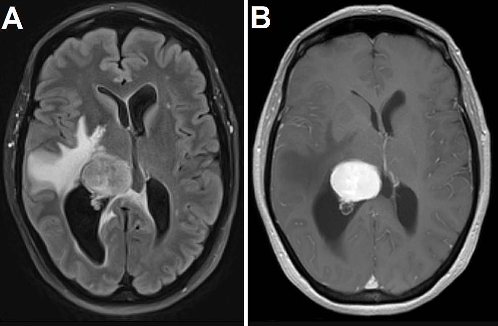 Magnetic-resonance-imaging-of-the-brain-with-fluid-attenuated-inversion-recovery-(A)-and-gadolinium-enhanced-T1-weighted-(B)-images-demonstrating-an-avidly-contrast-enhancing,-well-demarcated-intraventricular-tumor-with-associated-vasogenic-edema.