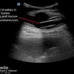 Sagittal-and-sonographic-image-of-the-vessel-with-the-graft-fracture.