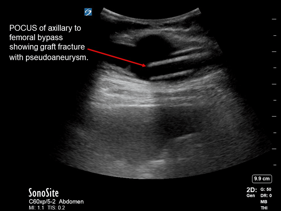 Sagittal-and-sonographic-image-of-the-vessel-with-the-graft-fracture.